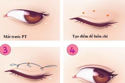 Tạo mí mắt