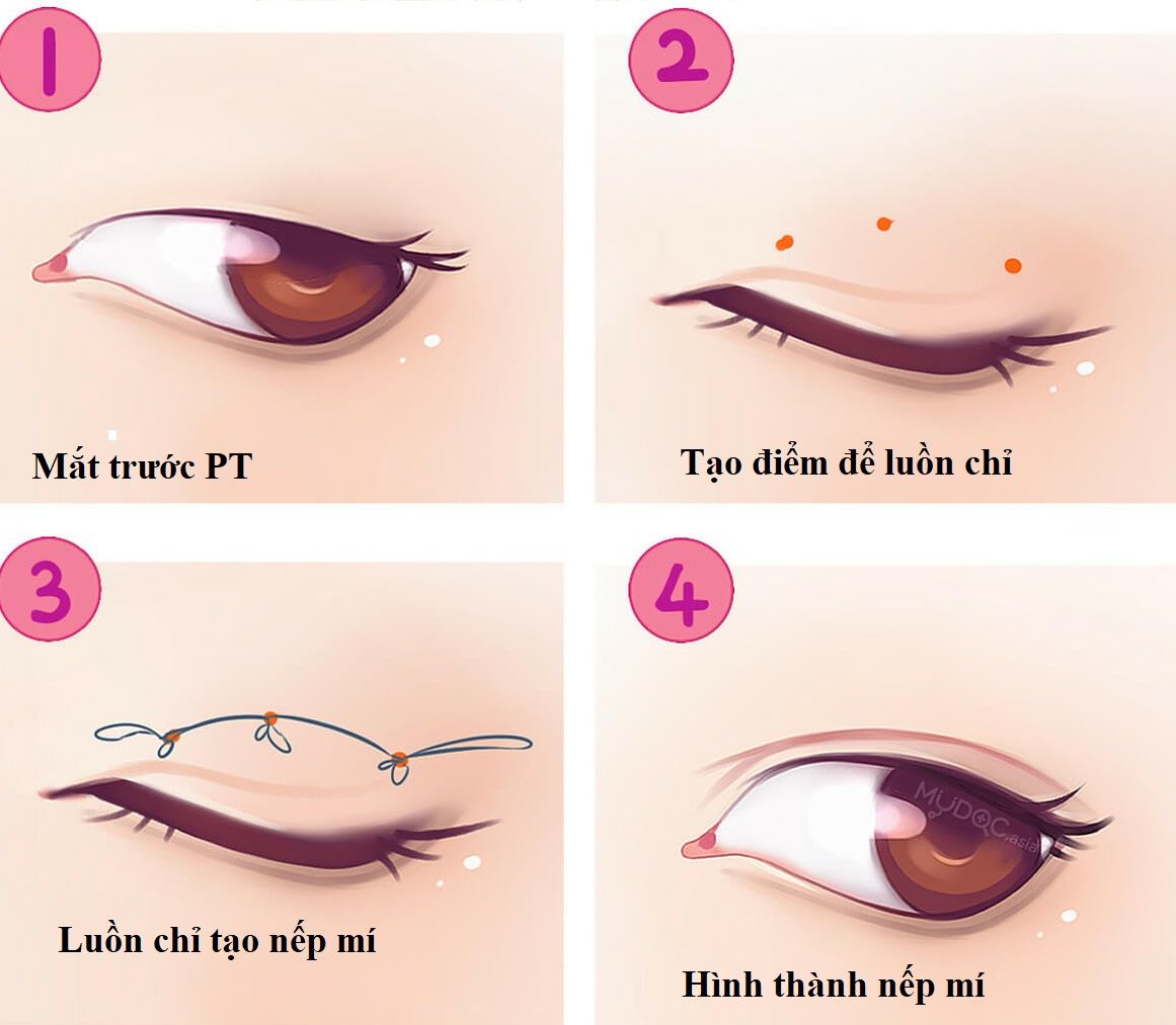 Tạo mí mắt