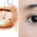 nhan-mi-mat-khong-phau-thuat1