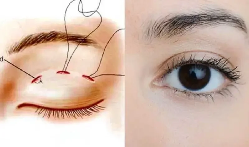 nhan-mi-mat-khong-phau-thuat1