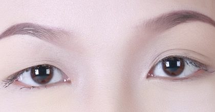 tạo mắt 2 mí 1 bên