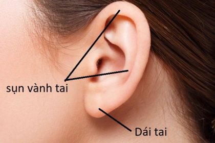 nâng mũi sụn vành tai