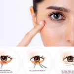 tạo mí mắt dưới