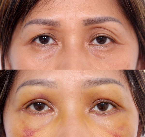 Phẫu thuật mí mắt dưới giúp lấy đi bọng mỡ hoặc phần da thừa kém sắc