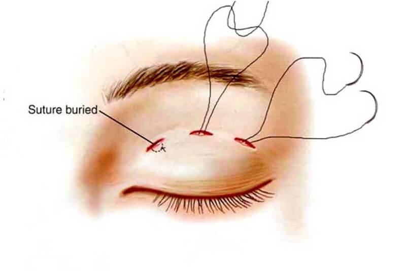 Bấm mí là phương pháp tạo hình mắt hai mí không phẫu thuật 