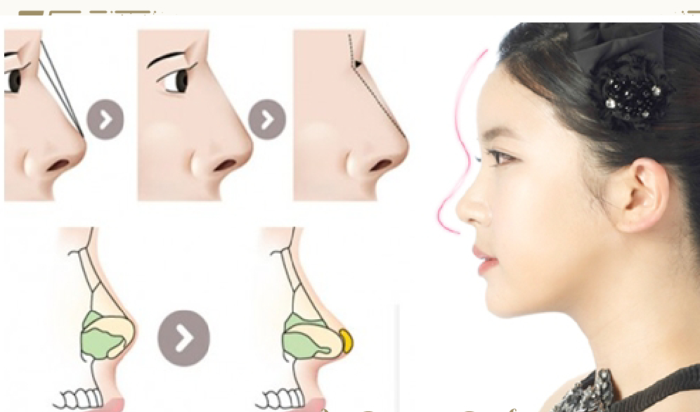 Nâng mũi là ca tiểu phẫu có xâm lấn