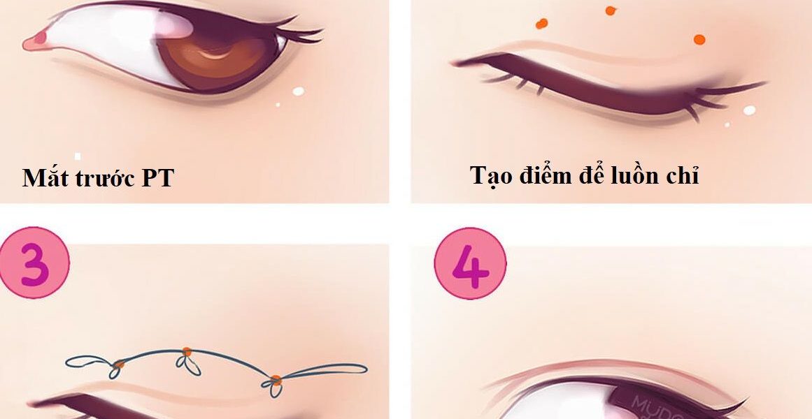 Tạo mí mắt