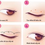 Tạo mí mắt