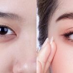 tạo mí mắt tự nhiên