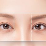 bác sĩ tạo mí mắt đẹp tại tphcm