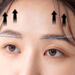 nâng cung chân mày có ảnh hưởng gì không