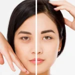 nâng chân mày trên là gì