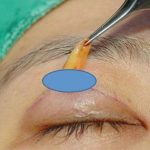 nhấn mí có lấy mỡ mắt được không