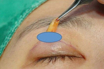 nhấn mí có lấy mỡ mắt được không