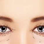 tạo mí đôi ở đâu đẹp tphcm