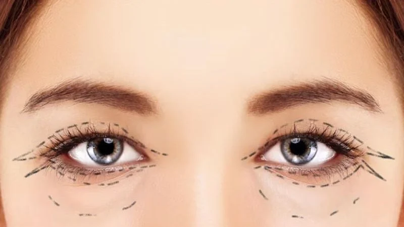 tạo mí đôi ở đâu đẹp tphcm