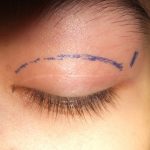 cắt mí phải nghĩ dưỡng mấy ngày