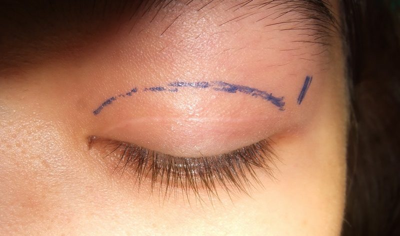 cắt mí phải nghĩ dưỡng mấy ngày