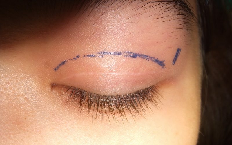 cắt mí phải nghĩ dưỡng mấy ngày