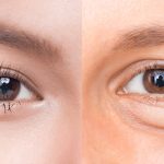 lấy mỡ bọng mắt có đau không