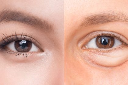 lấy mỡ bọng mắt có đau không