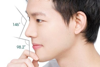 Nâng sống mũi nam giới